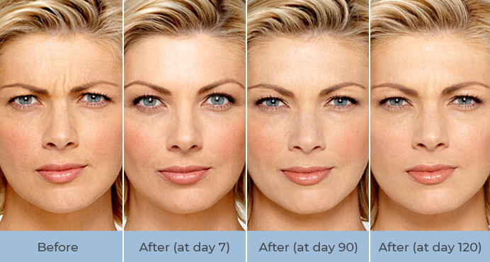 Woman botox treatment before and after
