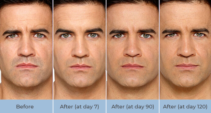 Male botox treatment before and after