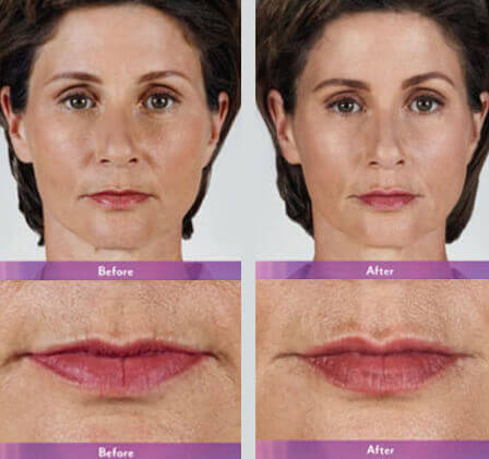 Juvederm Volbella Before and After