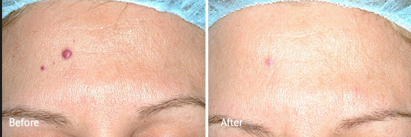 Laser Treatment of Angioma Before and After