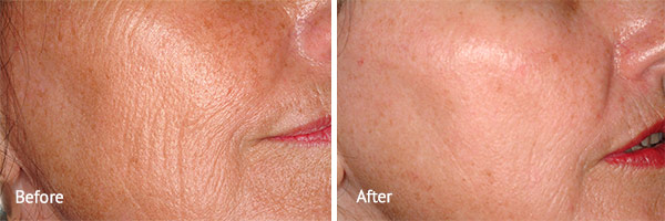 Fractional Skin Resurfacing Before and After