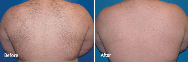 Hair Removal Laser Treatment Before and After