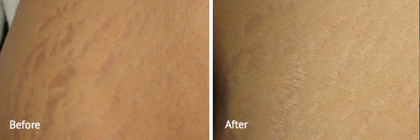 Stretch Marks Laser Treatment Before And After