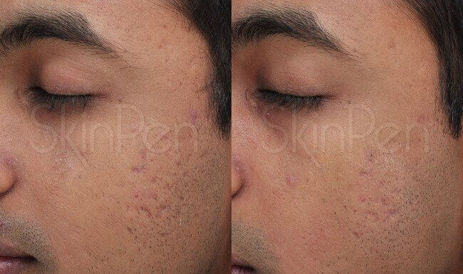SkinPen® treatment on male before and after