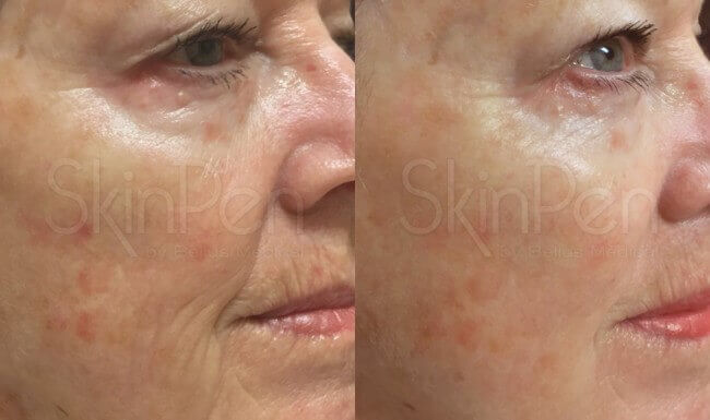 SkinPen® treatment on woman before and after