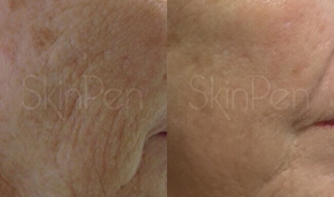 SkinPen® treatment before and after close up